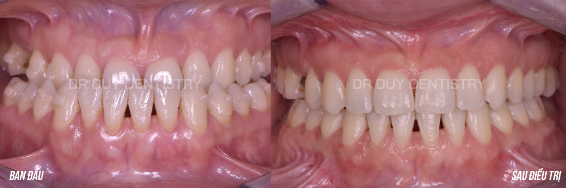 Răng cắn ngược dr duy dentistry