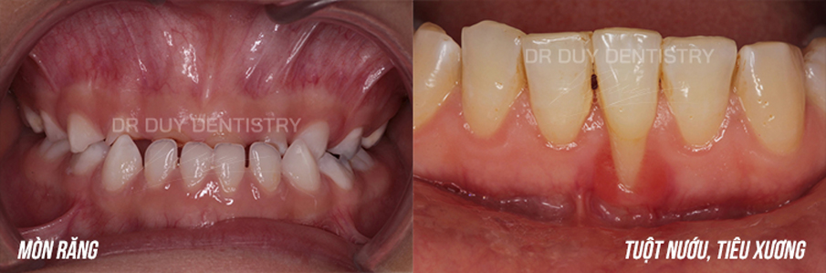 cắn ngược dr duy dentistry