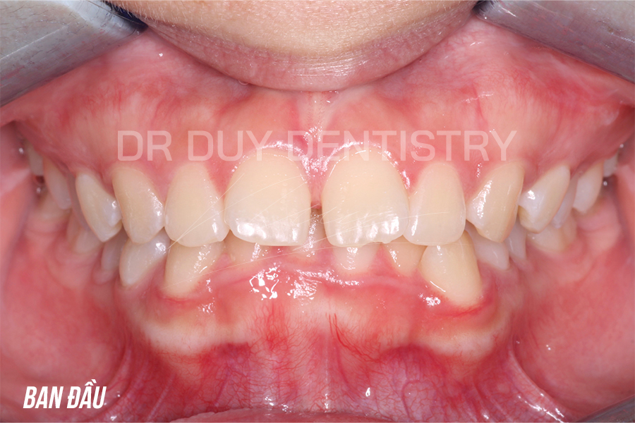 điều trị khớp cắn sâu tại nha khoa dr duy dentistry