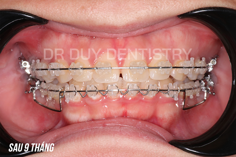 điều trị khớp cắn sâu tại nha khoa dr duy dentistry