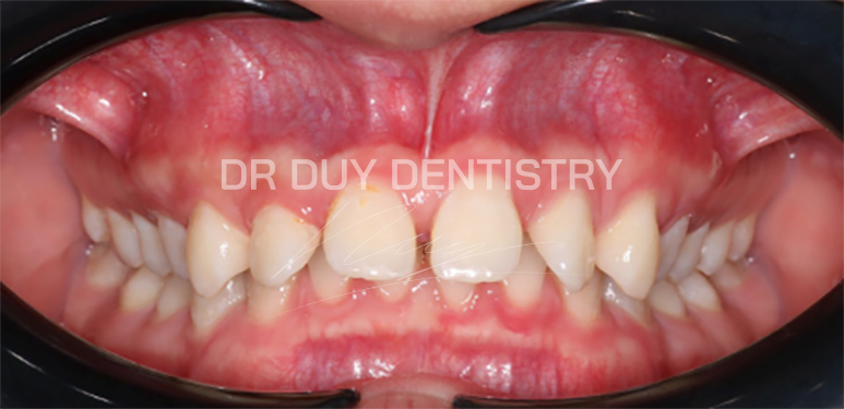 khớp cắn sâu - nha khoa dr duy dentistry