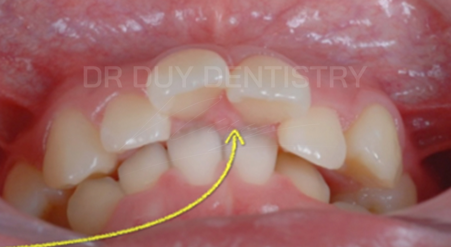 khớp cắn sâu - nha khoa dr duy dentistry