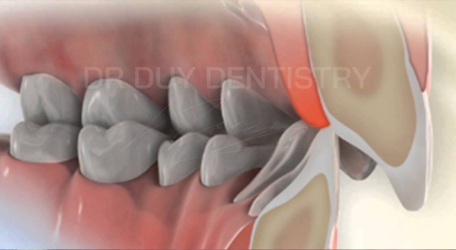 khớp cắn sâu - nha khoa dr duy dentistry