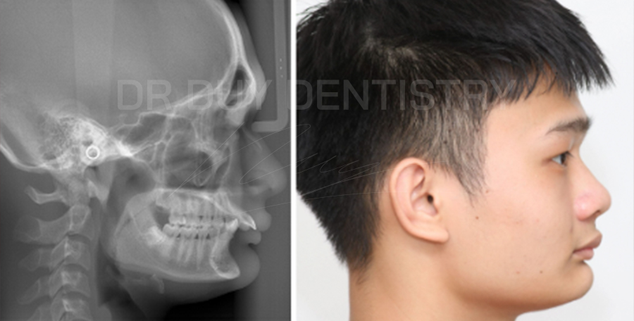 khớp cắn sâu - nha khoa dr duy dentistry