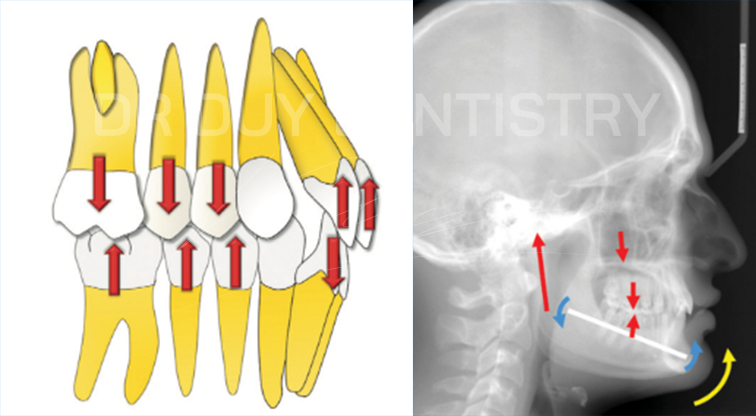 khớp cắn sâu - nha khoa dr duy dentistry