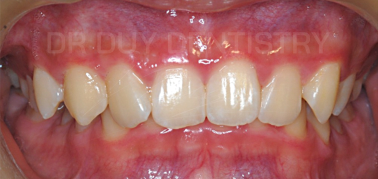 điều trị khớp cắn sâu tại nha khoa dr duy dentistry