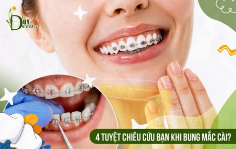 4 Tuyệt chiêu cứu bạn khi bung mắc cài