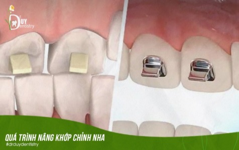 NÂNG KHỚP CẮN TRONG NHỮNG TRƯỜNG HỢP NÀO?