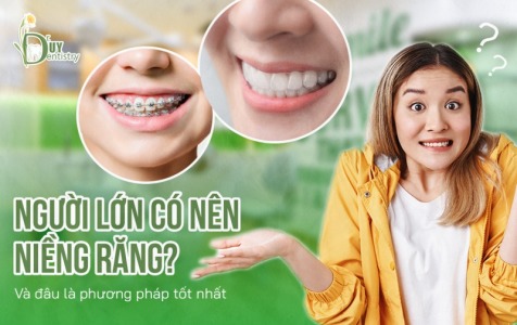 Người Lớn Có Nên Niềng Răng?