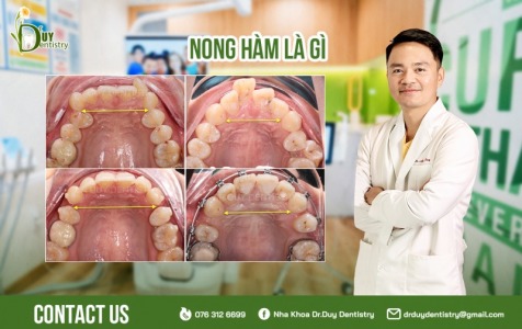 Nong hàm là gì?